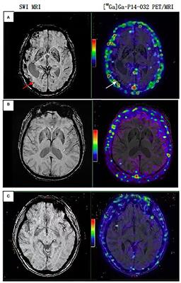 Evaluating [68Ga]Ga-p14-032 as a Novel PET Tracer for Diagnosis Cerebral Amyloid Angiopathy